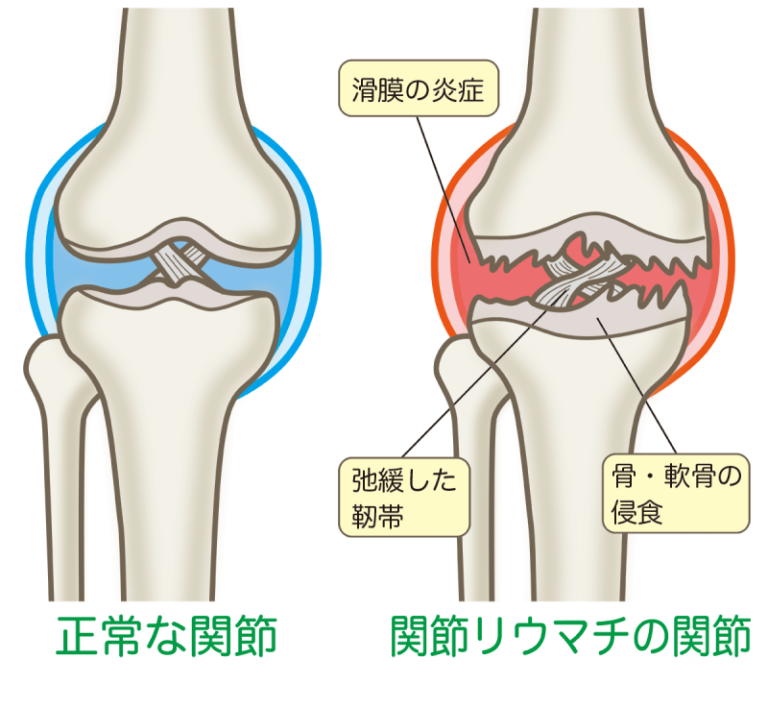 膝 曲げる と 痛い 突然