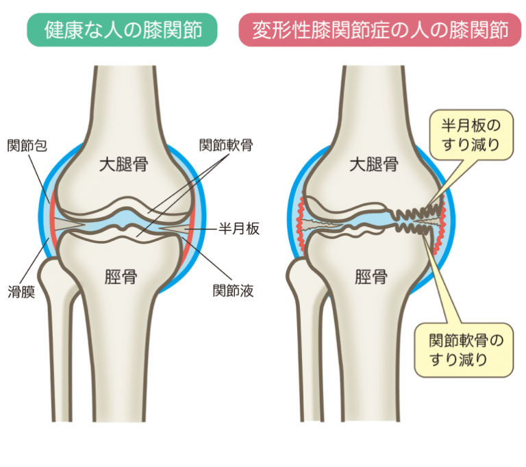 変形性膝関節症
