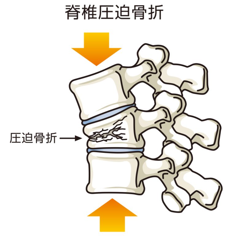 圧迫骨折