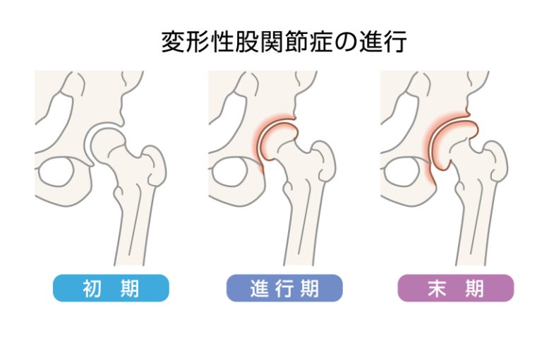 変形性股関節症