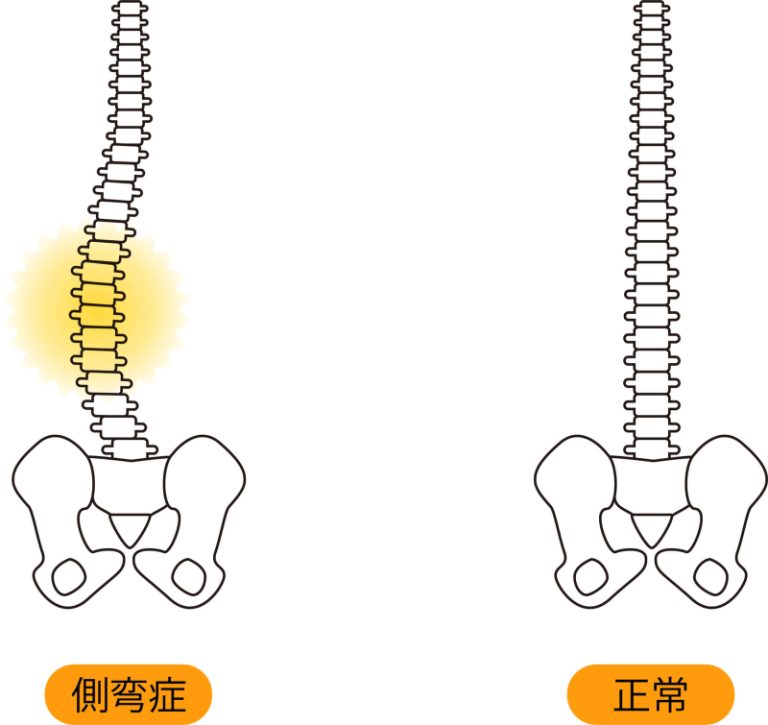 側弯症