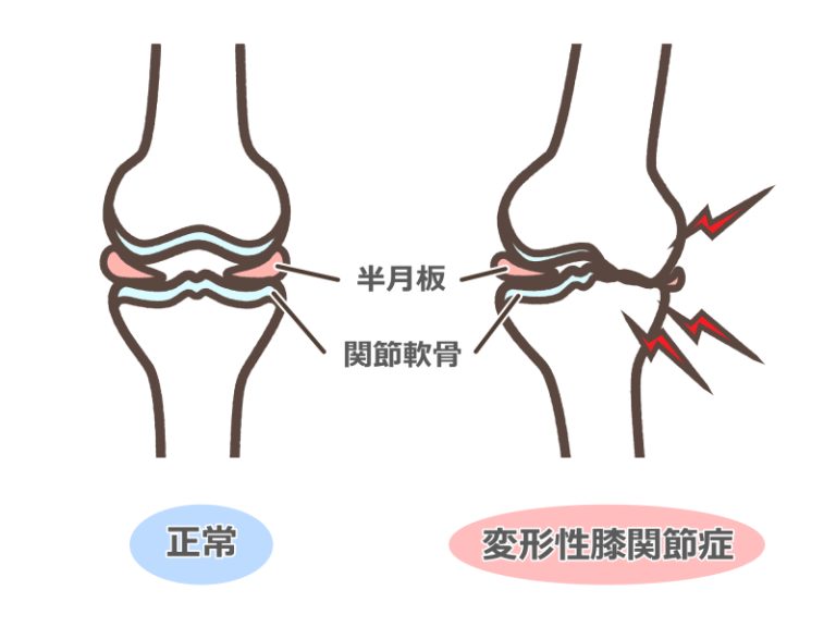 変形せ股関節症