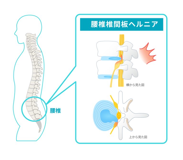 腰部椎間板ヘルニア