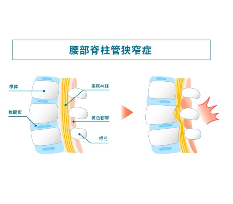 腰部脊柱管狭窄症